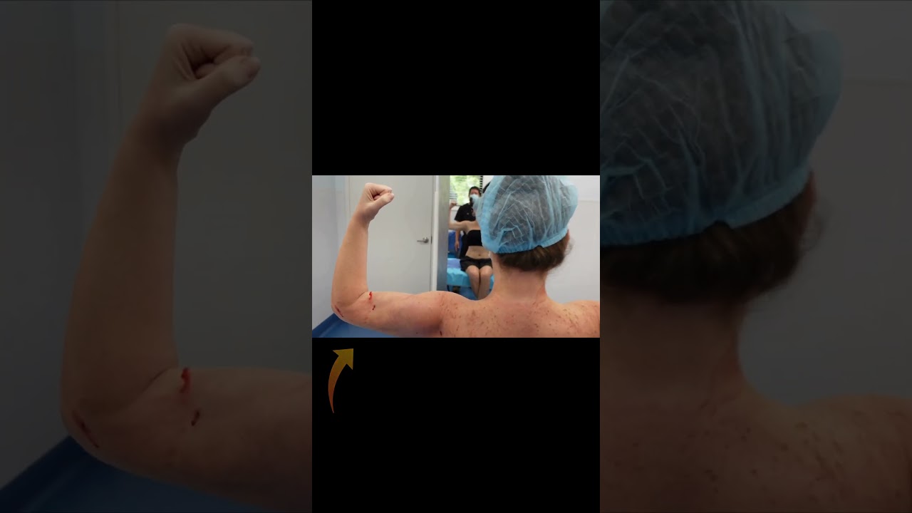360&deg; Arm Liposuction | Celebrity Arms&trade; | Immediate Results | Expert Dr. Thomas Su | Artlipo
