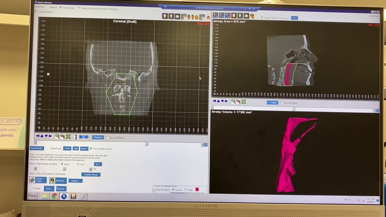 How to Measure Airway Area and Volume on CBCT in Dolphin Software | Orthodontic CBCT Analysis