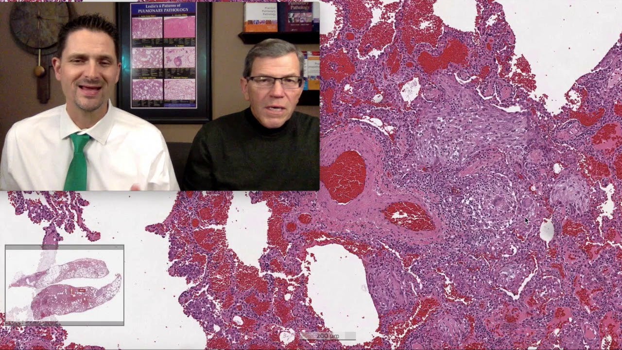 Pattern 4 – Alveolar Filling, Aspiration Lung Injury (Top 25 Pearls Series, Topic 6, Pearl 5)