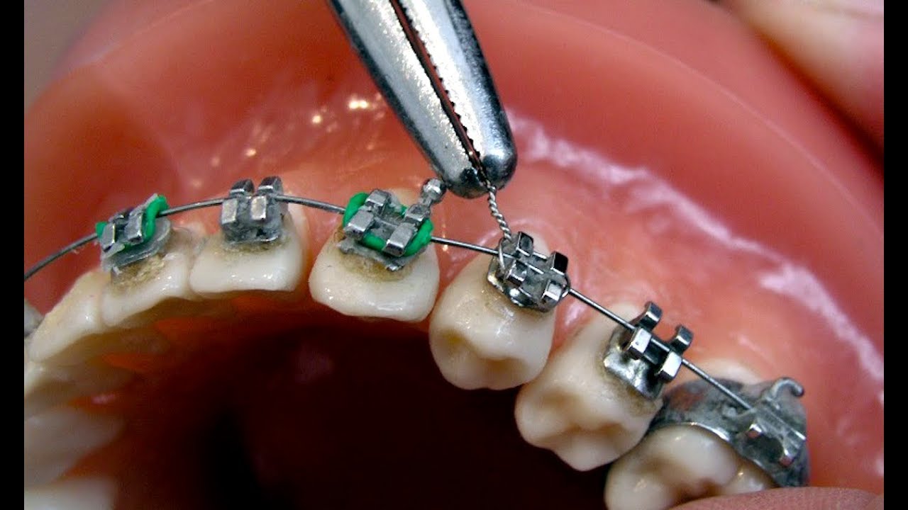 จัดฟันด้วยลวดลิเกเจอร์ (ligature wire)