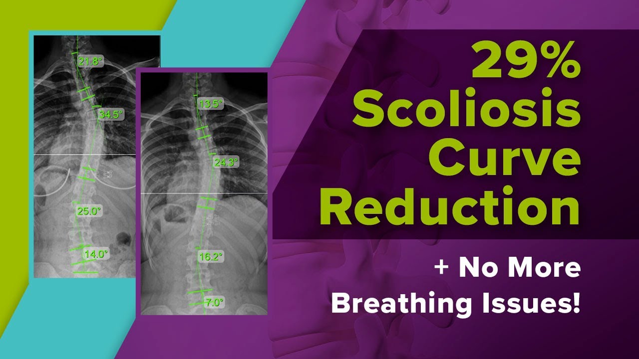 29% Scoliosis Curve Reduction + No More Breathing Issues!