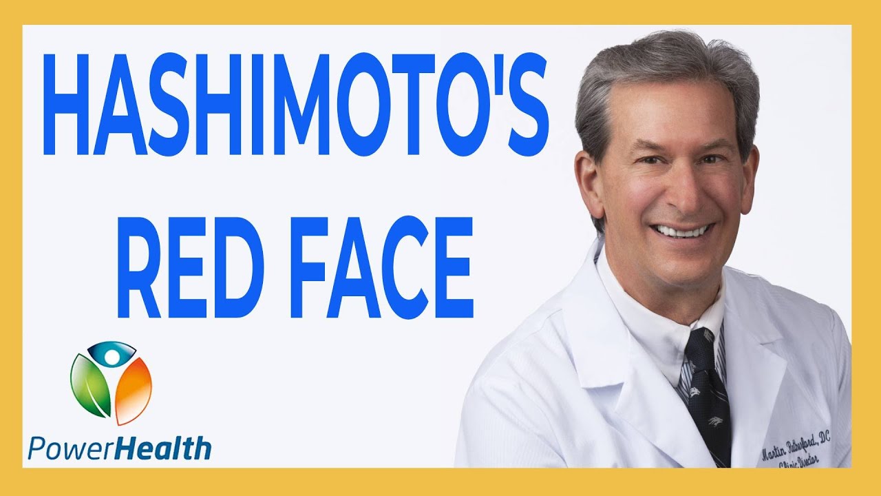 Hashimoto's and Red Face