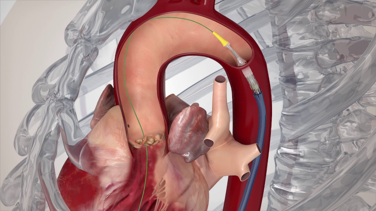 Edwards SAPIEN 3 TAVR (Transfemoral Implant Procedure Animation)