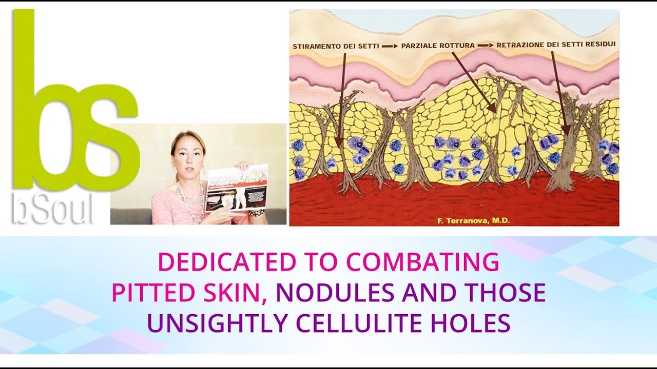 Video dedicated to combating pitted skin, nodules and those unsightly cellulite holes 