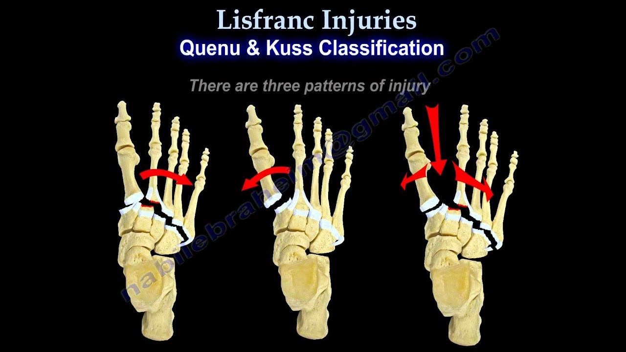 Lisfranc Injuries - Everything You Need To Know - Dr. Nabil Ebraheim