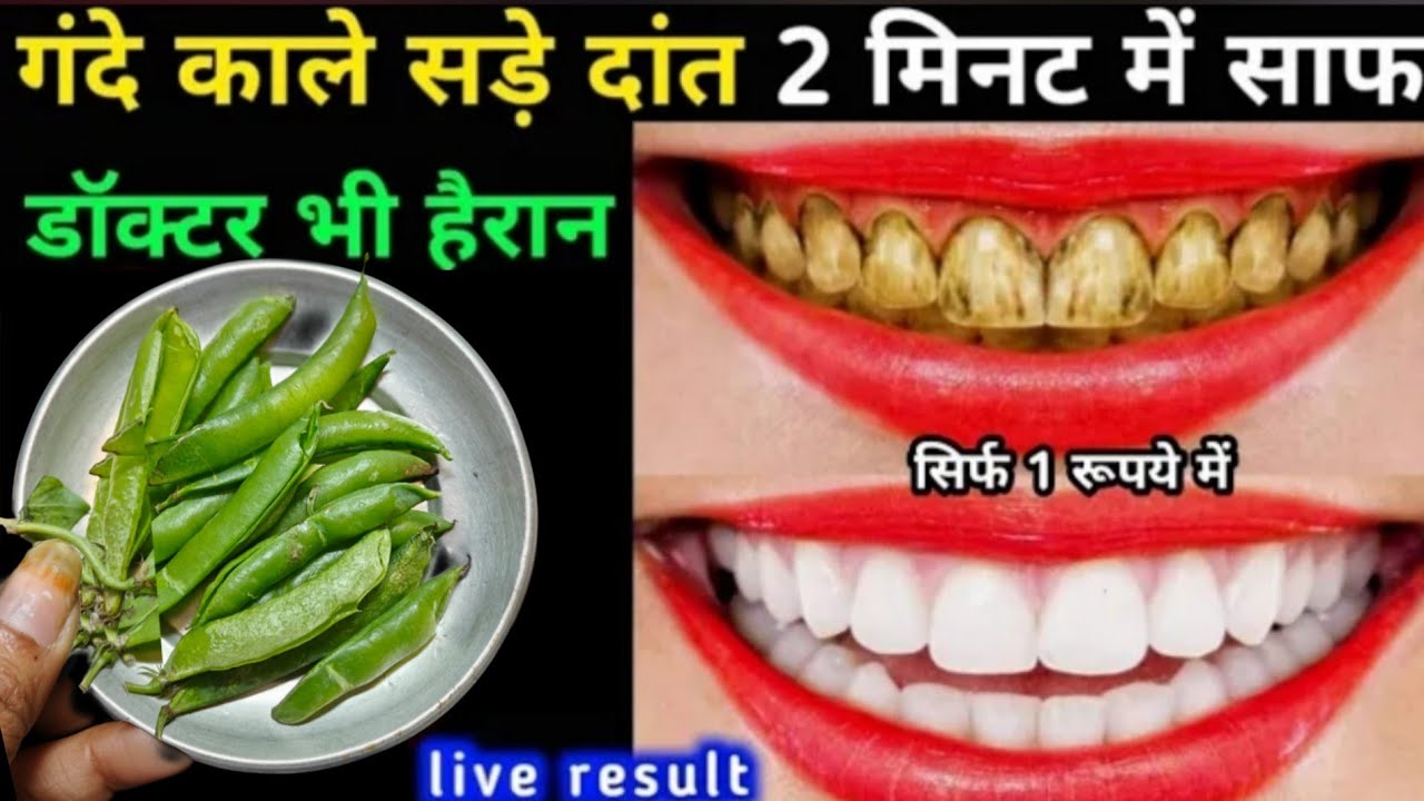 सिर्फ 1 रूपये में गंदे सड़े पीले दांतों को मोती की तरह चमका देगा /Teeth whitening remedy