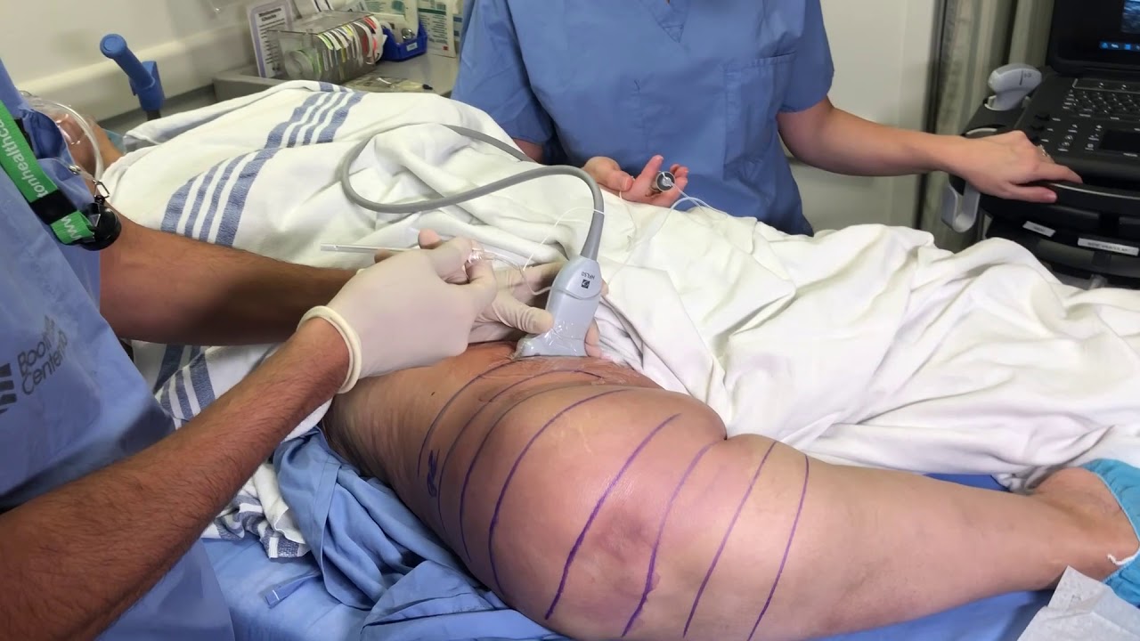 Watch An Adductor Canal Nerve Block For Total Knee Replacement - Does It Work?