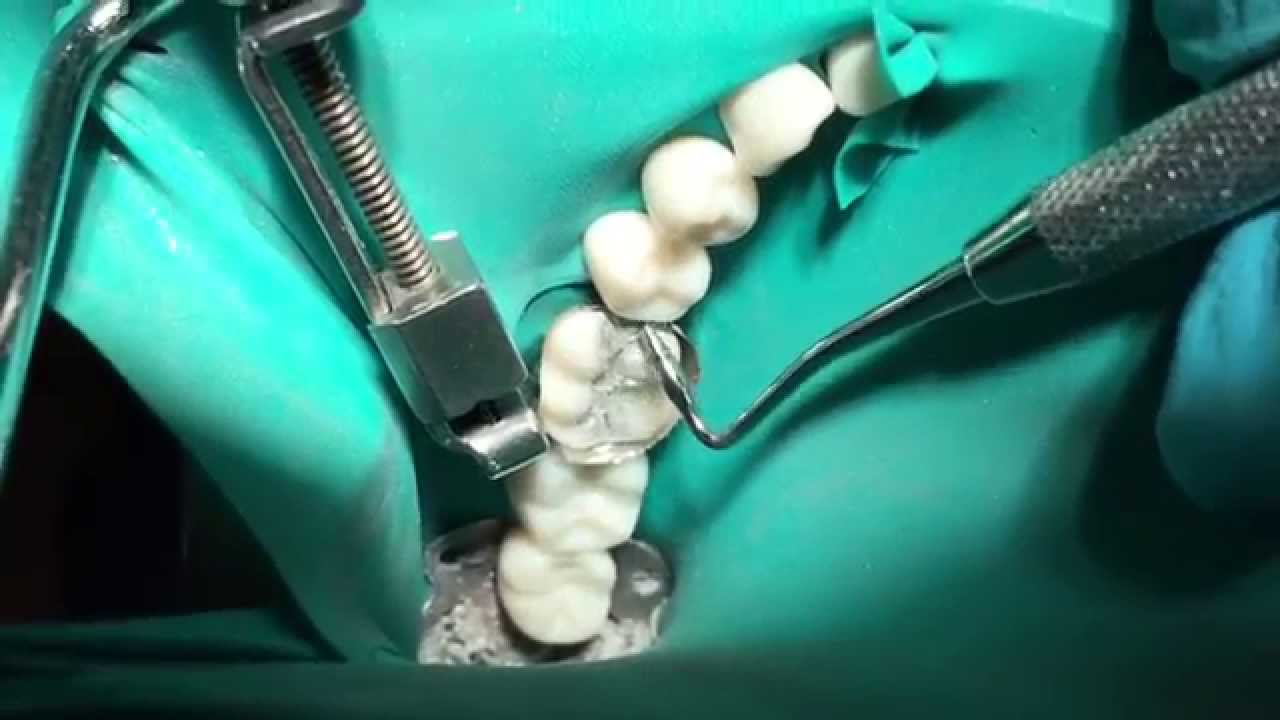 Class II Amalgam restorations- Weekend in Sim lab 2.15.15