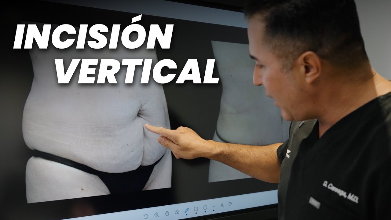 Incisión Vertical en la Abdominoplastia: Todo lo que Debes Saber