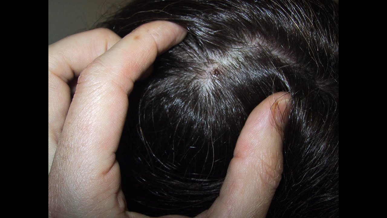 How to Treat a Dry Scalp [DermTV.com Epi #482]