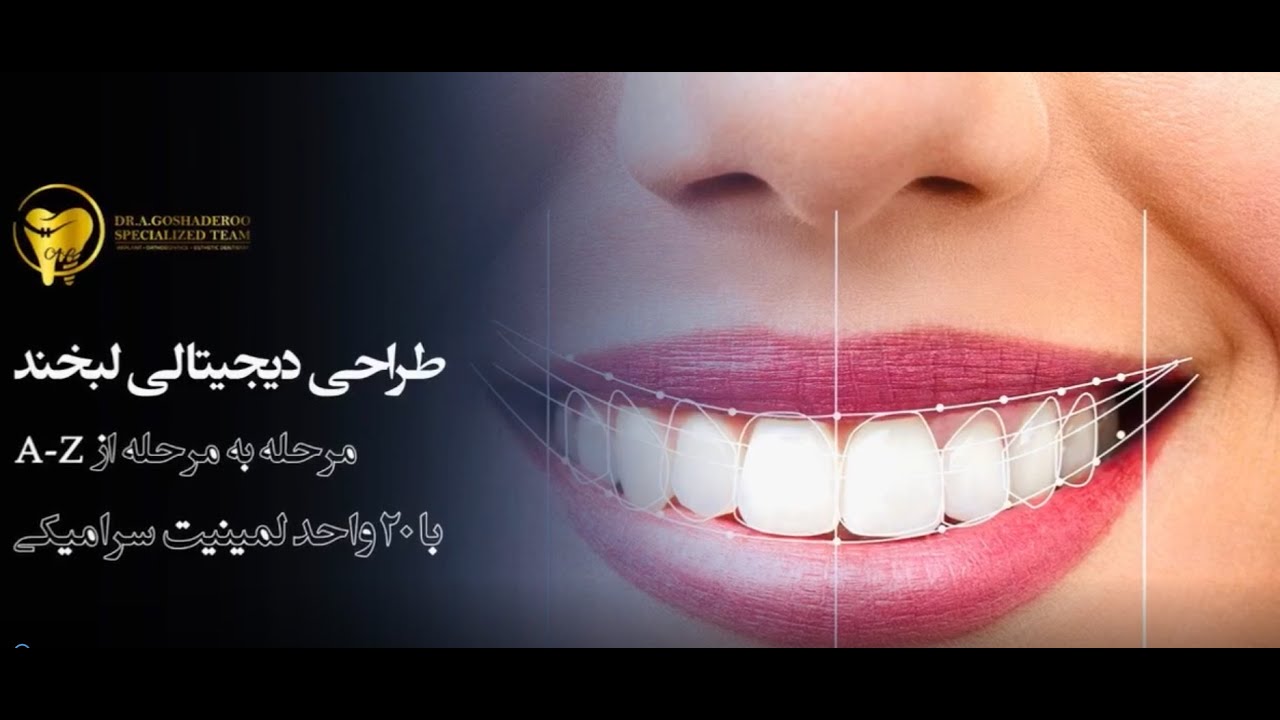 طراحی لبخند دیجیتال دکتر گشاده‌رو _ Step by step to a customize smile design
