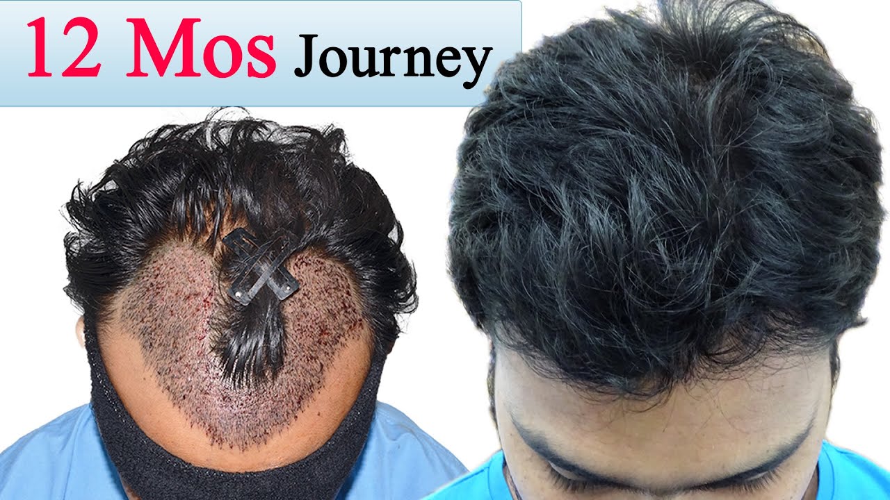 Best Hair Transplant in India Results you must watch Jaipur hair transplant clinic