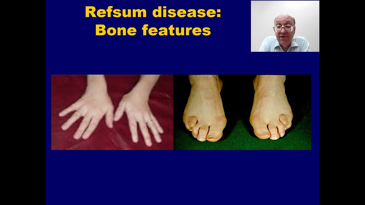 Introduction to Adult Refsum Disease