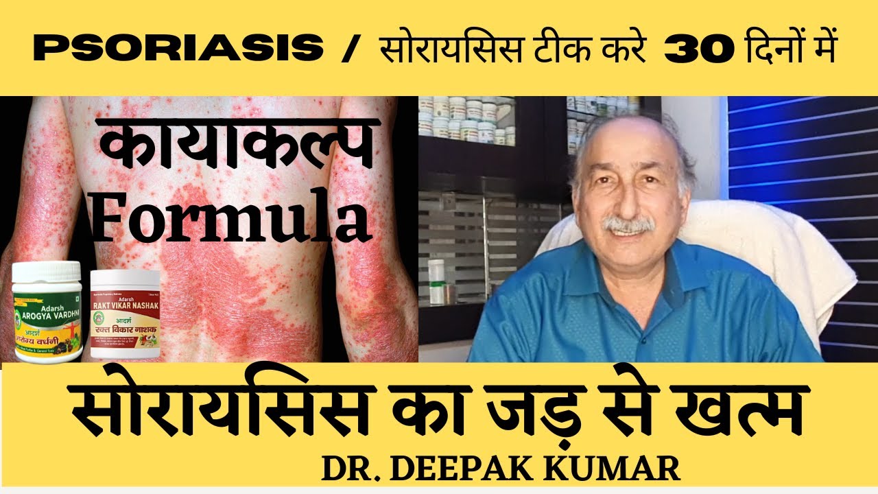 बिना किसी STERIOD के PSORIASIS को ठीक करें 30 दिन के कल्प से | #psoriasis #dietplan