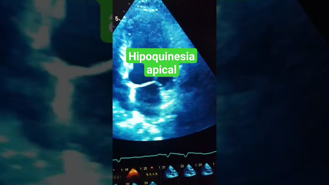 Hipoquinesia de segmentos apicales