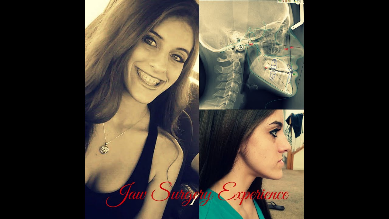 Jaw Surgery Journey