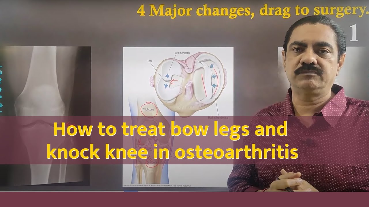 How to treat bow legs and knock knee in osteoarthritis