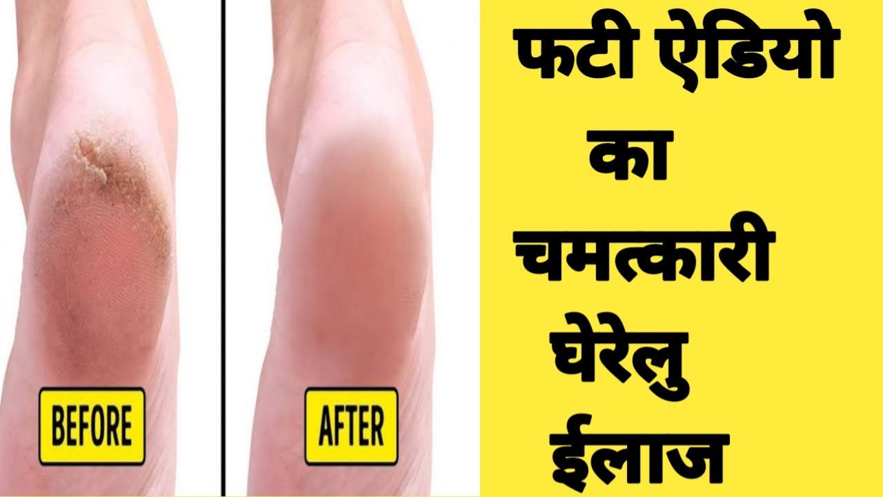 Home Remedy for Cracked Heels - फटी ऐडियो का चमत्कारी घेरेलु ईलाज | BeautyUtsav