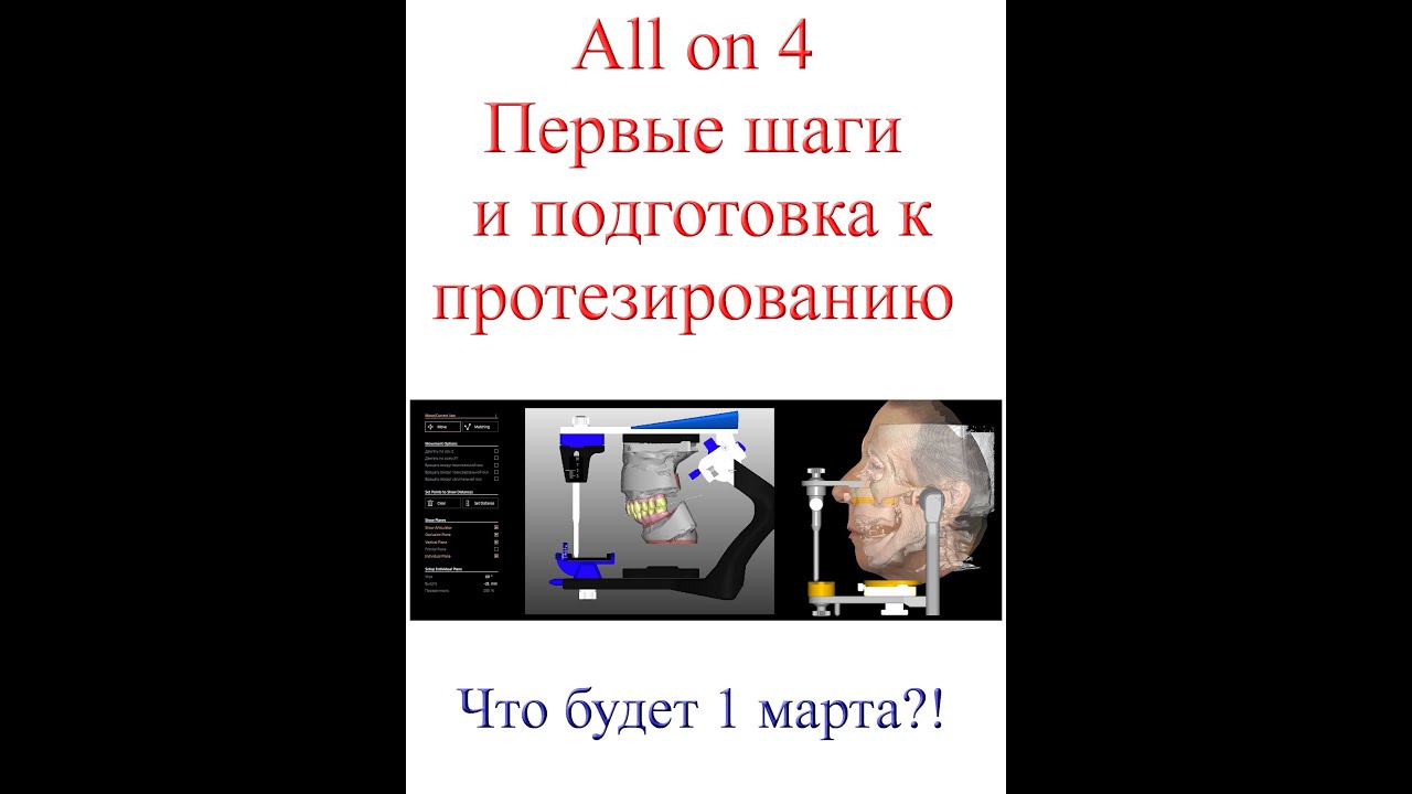 All on 4  -  ВСЁ на ЧЕТЫРЁХ! Или первые шаги к правильному протезированию