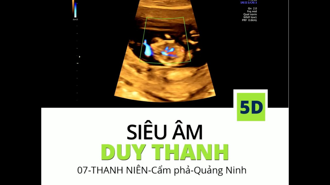 TRAP SEQUENCE TWINS ULTRASOUND