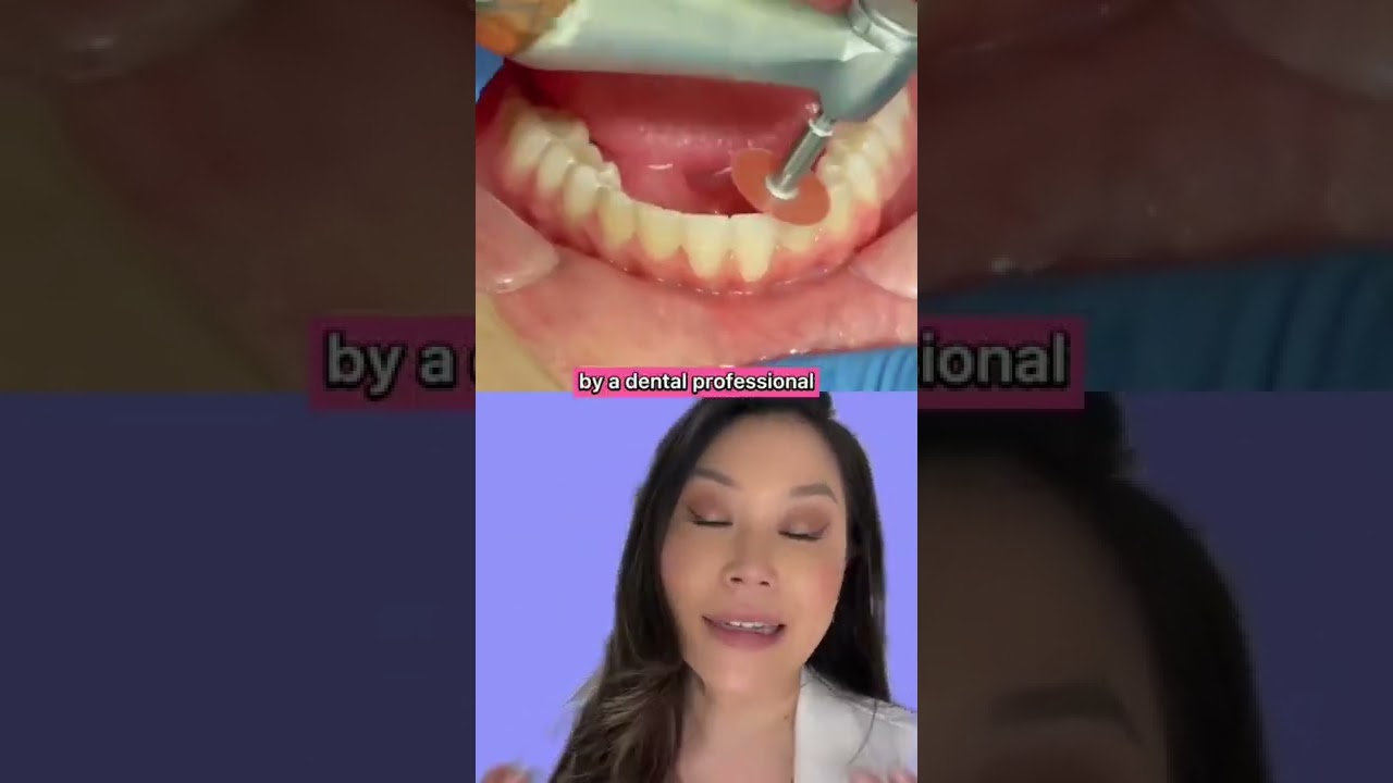 BTS Reshaping bumps on teeth (Mamelons) with Enameloplasty using Sanding Disc #mamelons