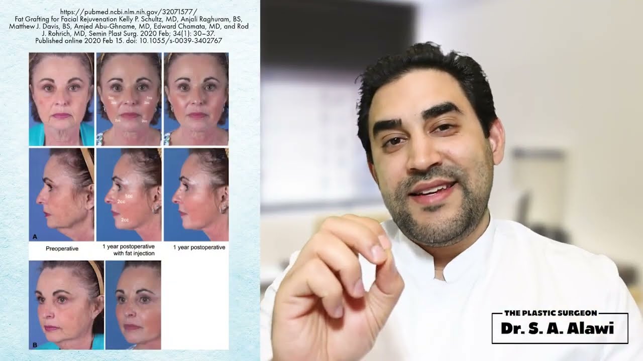 Gesichtsverjüngung durch Fettabsaugung und Lipofilling | Dr. Alawi