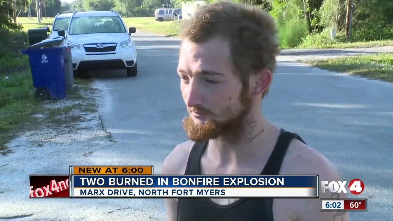 Two severely burned in bonfire accident in North Fort Myers