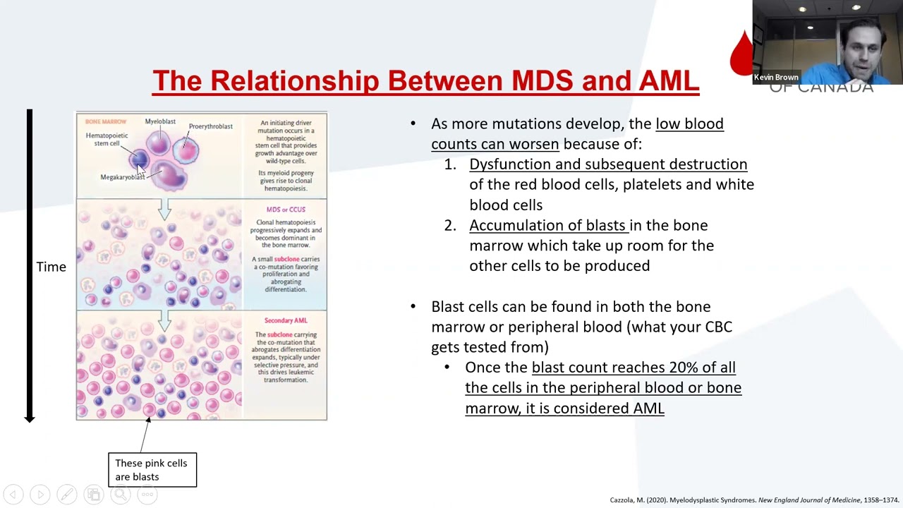 MDS transformation to AML