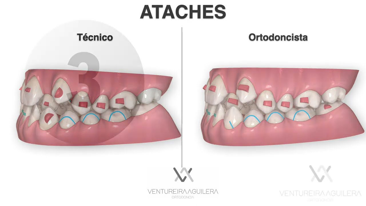 Claves para mejorar la PREDICTIBILIDAD en Compresiones Esqueléticas y Mordidas Cruzadas: INVISALIGN