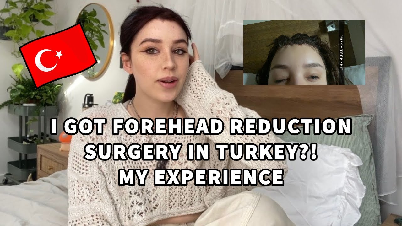 forehead reduction surgery/ hairline lowering my experience: *results* pics + vids