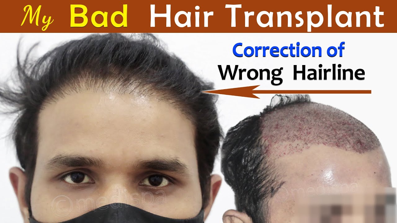 Hairline correction Surgery | Hairline Restoration | Best Hair Transplant Results | Hairline Design