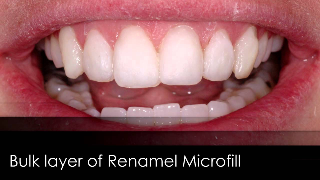 Composite Veneers - Enamel Replacement