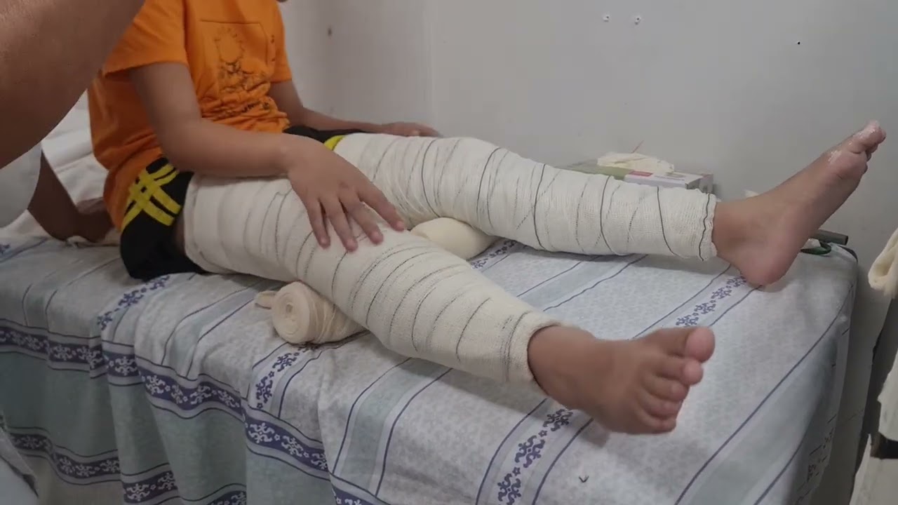 Posição  da tala  inguino maleolar  .