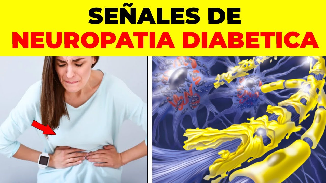 ASI EMPIEZA la NEUROPATIA DIABÉTICA y nadie te lo dice, signos y síntomas de neuropatía diabética