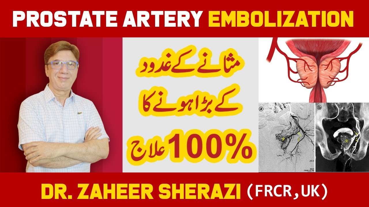 Prostatic Artery Embolization | Enlarged Prostate | Masana ki gadood ka ilaj