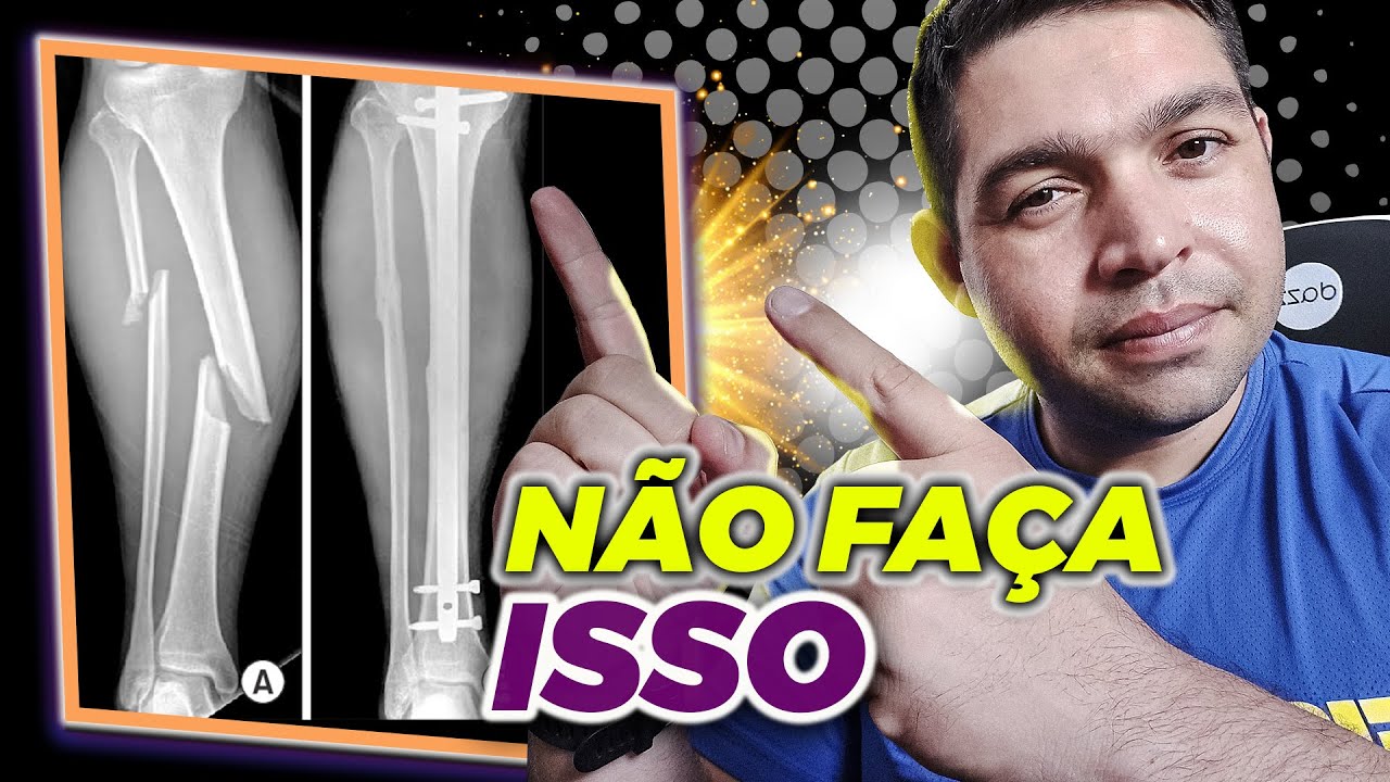 FIZ CIRURGIA NA FRATURA DA TÍBIA E NA FRATURA DA FÍBULA NÃO
