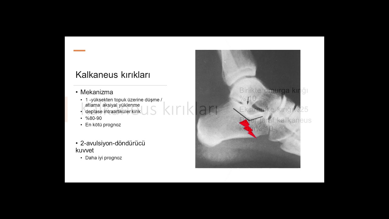 KALKANEUS : TOPUK KEMİĞİ KIRIKLARI