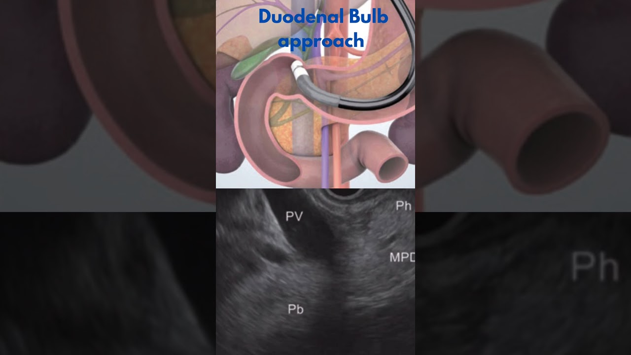 LEARN EUS- BASICS #endoscopic #ultrasound #gastroenterologist #hepatology #medicalstudent