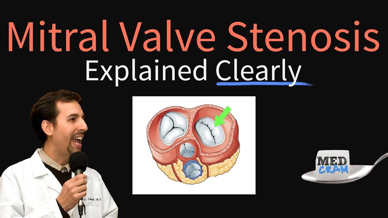 Mitral Valve Stenosis Explained Clearly - Pathophysiology, Symptoms, Treatment