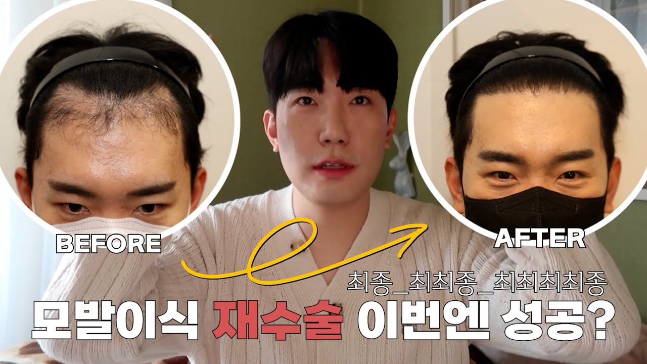 모발이식 보강수술 후 1년! 리얼한 경과 사진후기