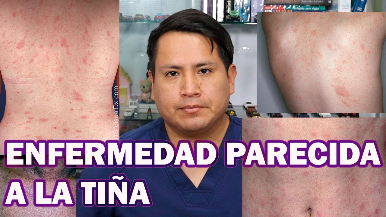 CÓMO ELIMINAR LA PITIRIASIS ROSADA