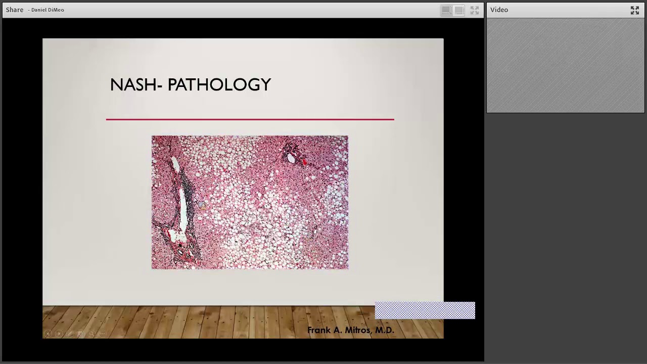 5 2 1 0 Webinar  Pediatric Obesity Co Morbidities  NAFLD, NASH 0 0