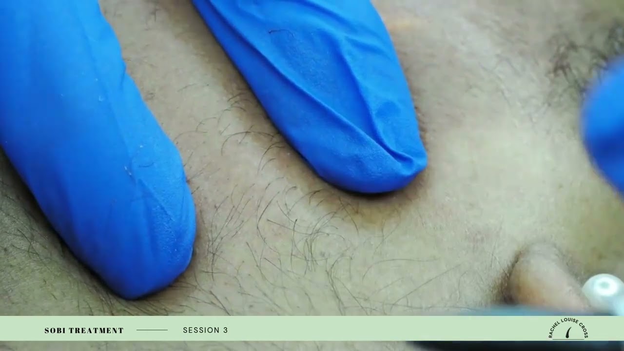 Dr Sobi Electrolysis Journey - Session 3