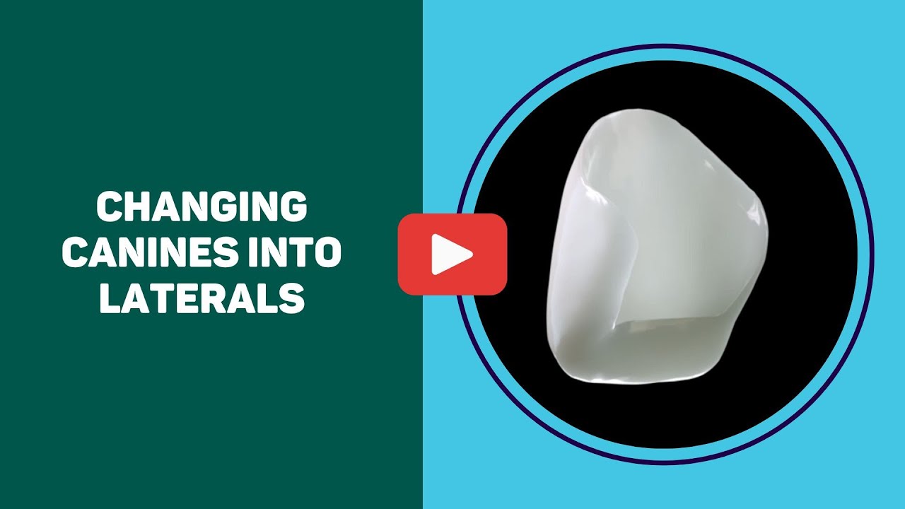 Changing Canines into Laterals - Congenitally Missing Front Teeth