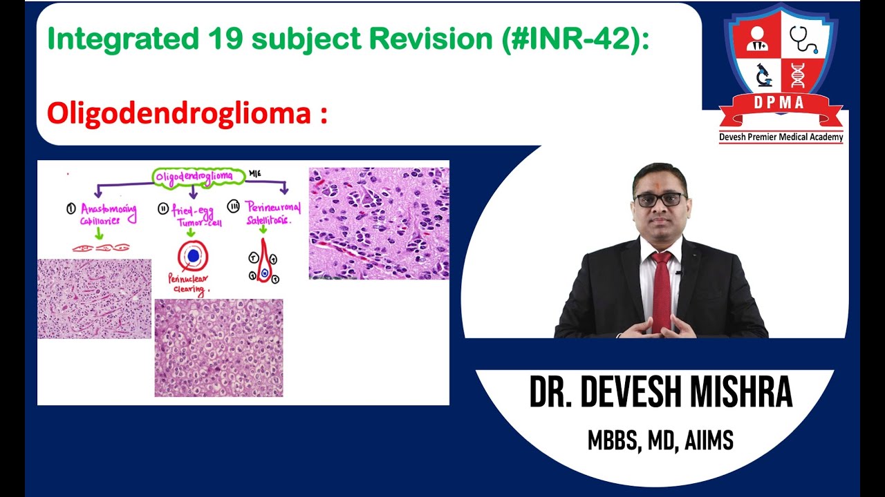 🕉 Integrated 19 subject Revision (#INR-42): Oligodendroglioma by Dr. Devesh Mishra.