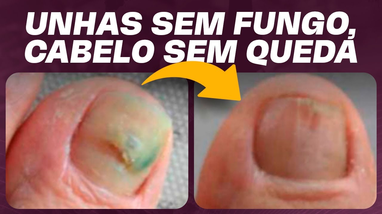 Ela tratou fungos nas unhas, diminuiu a queda de cabelo e amenizou olheiras