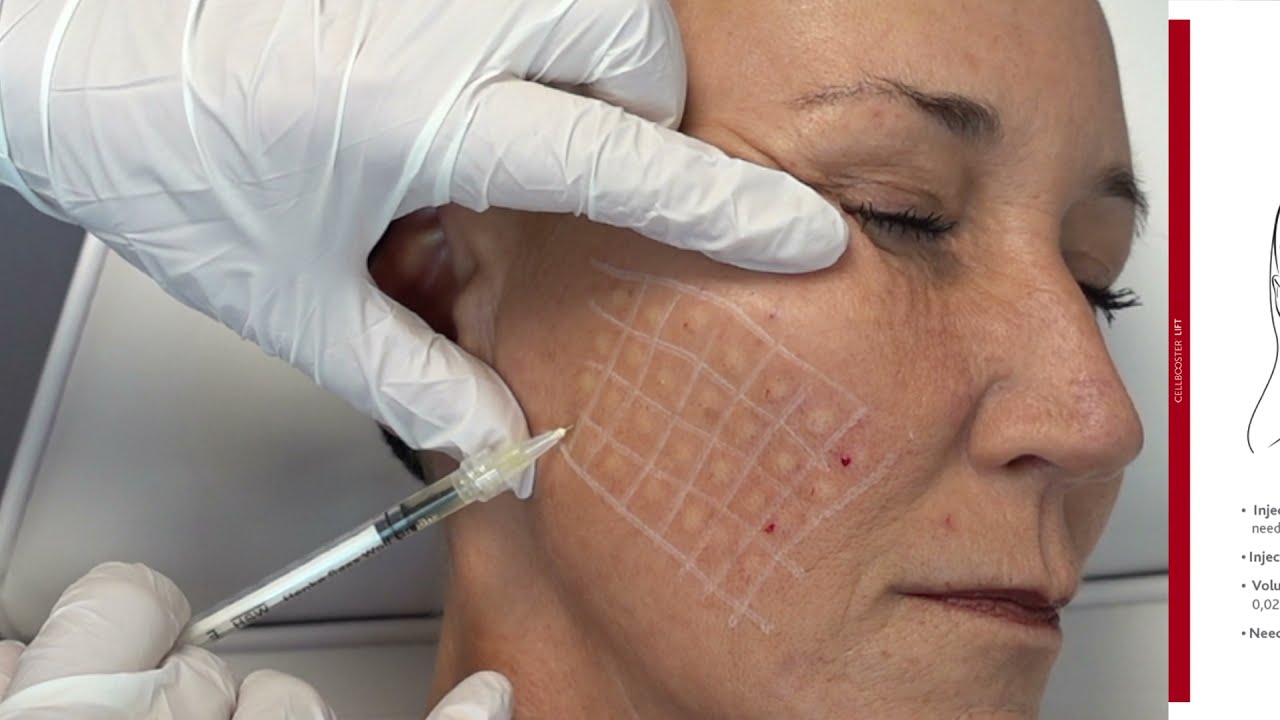Cellbooster Lift Papula Technique - Chat Technology