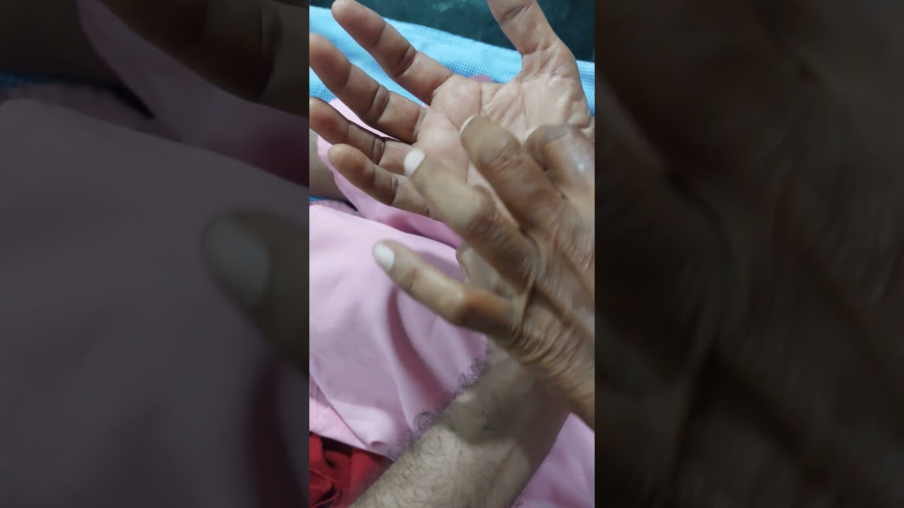 Carpal tunnel syndrome Part 3 in Telugu Durkans test 