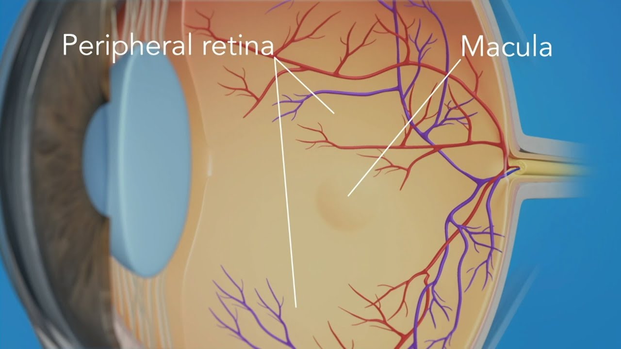 Treating Retinal Detachment with Retinal Consultants of Arizona