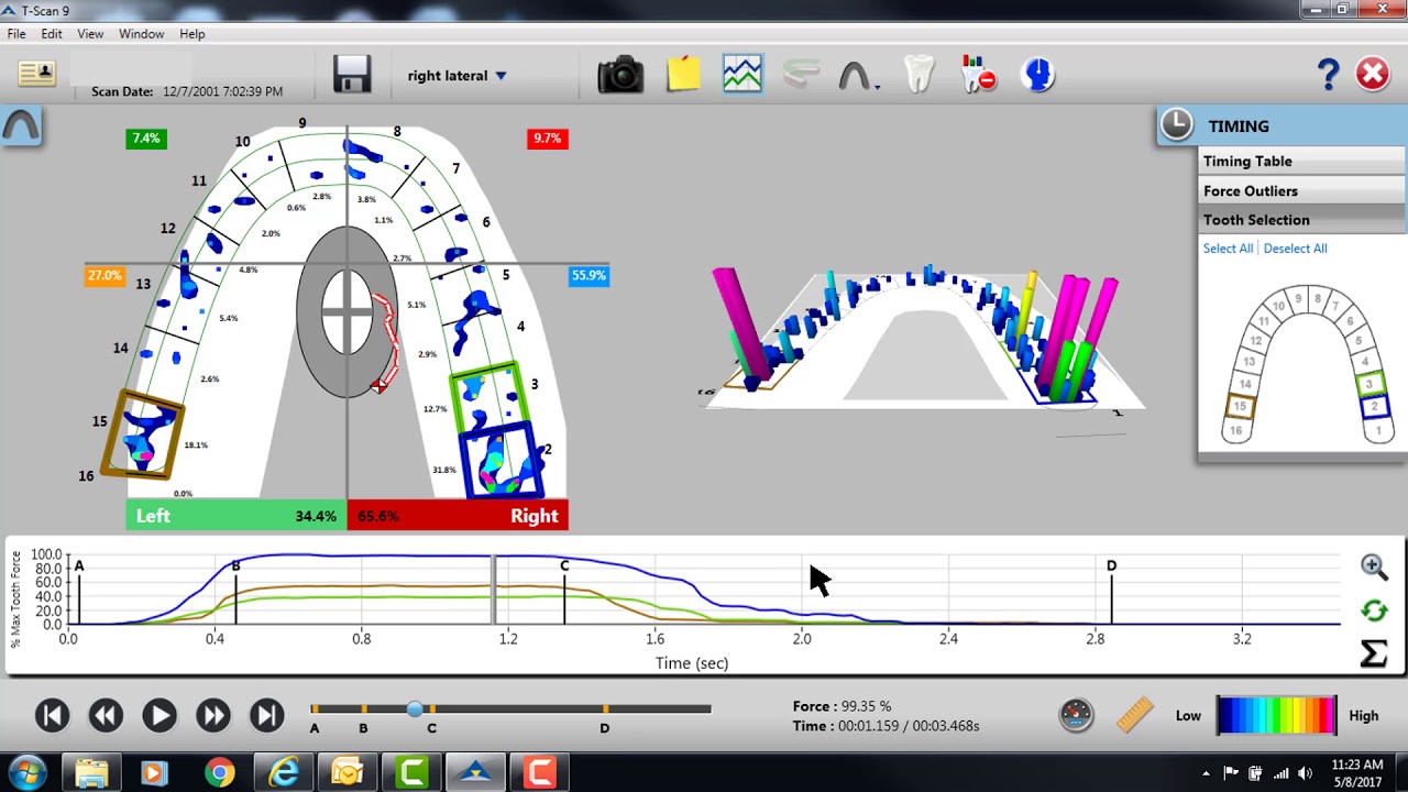 Adjusting Center of Force with T-Scan